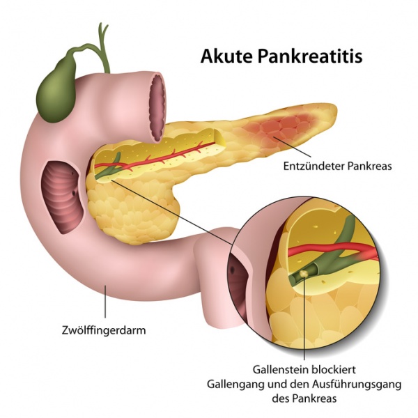 Datei:Akute Pankreatitis.jpg