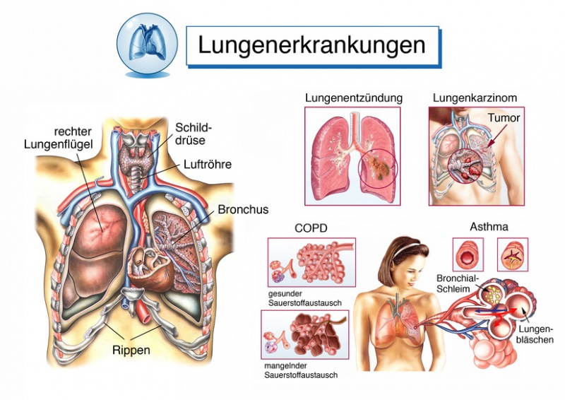 Datei:Lungenkrankheiten.jpg