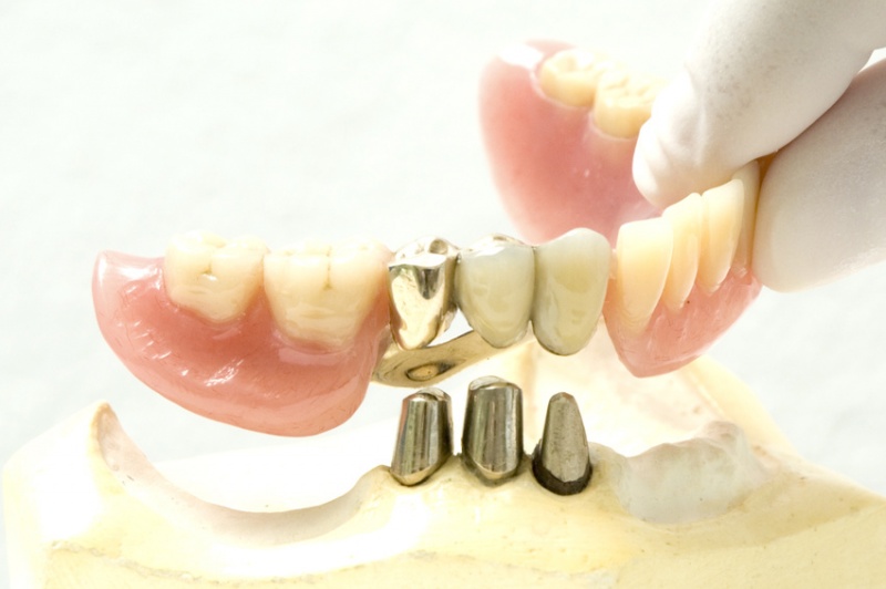 Datei:Zahnprothese.jpg